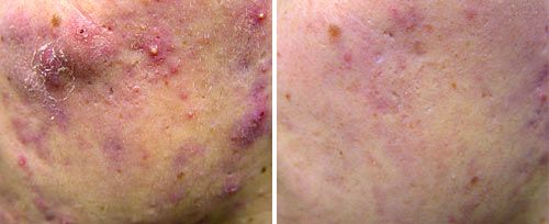 active_acne2_sult_rn