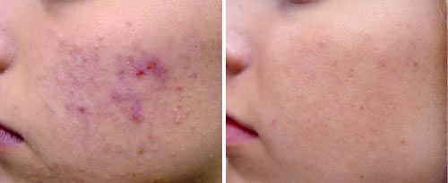 active_acne_sult_rn